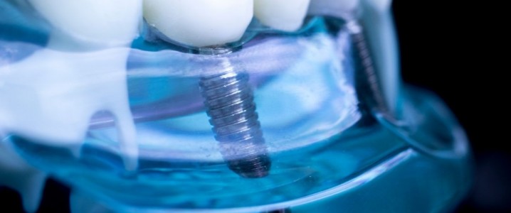 Implantologia Clínica Rio Este