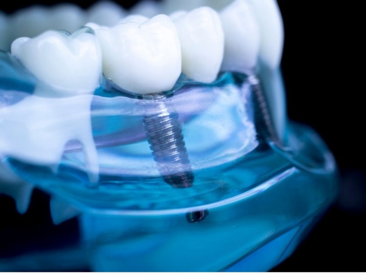 Implantologia Clínica Rio Este